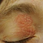 comment soigner l'eczema autour des yeux