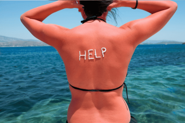 You are currently viewing Brulure, coup de soleil : soigner la peau après l’été