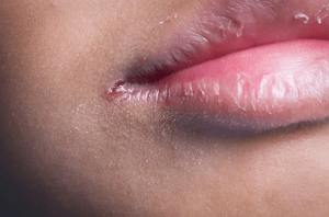 Chéilite angulaire ou perlèche du coin des lèvres