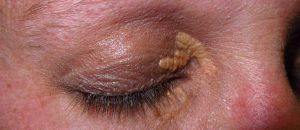 Problème de peau : xanthelasma plaques jaunes autour de l'oeil
