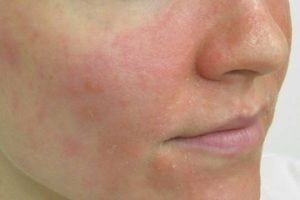 eczema contact dermatite allergique sur le visage