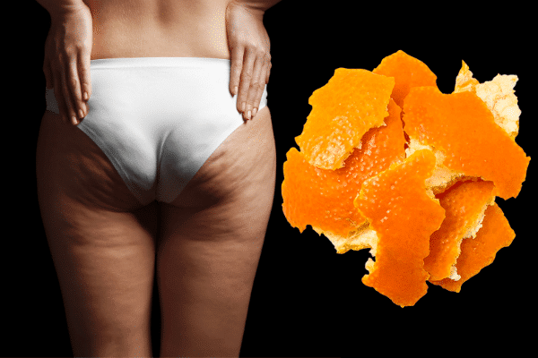 santé et beauté cellulite aspect peau d'orange