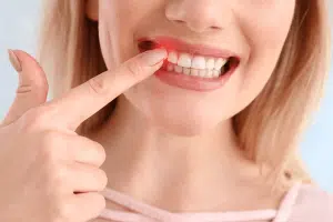 Gingivite Parodontite Maladie des gencives