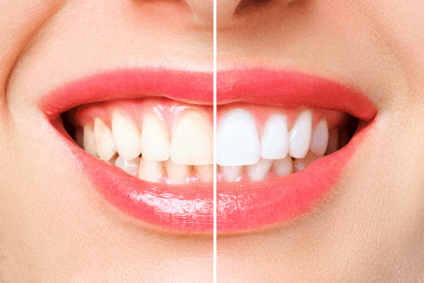 Dents blanches avant après