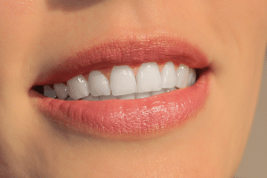 Dents blanches pour un beau sourire