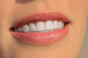 Dents blanches pour un beau sourire