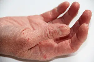 Crevasse sur les mains