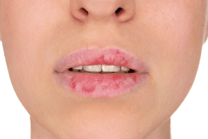 Lire la suite à propos de l’article Lèvres gercées : comment les réparer ?