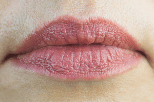 lèvres gercées et fines rides autour de la bouche