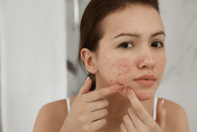 Lire la suite à propos de l’article Les meilleures routines de soins pour combattre l’acné