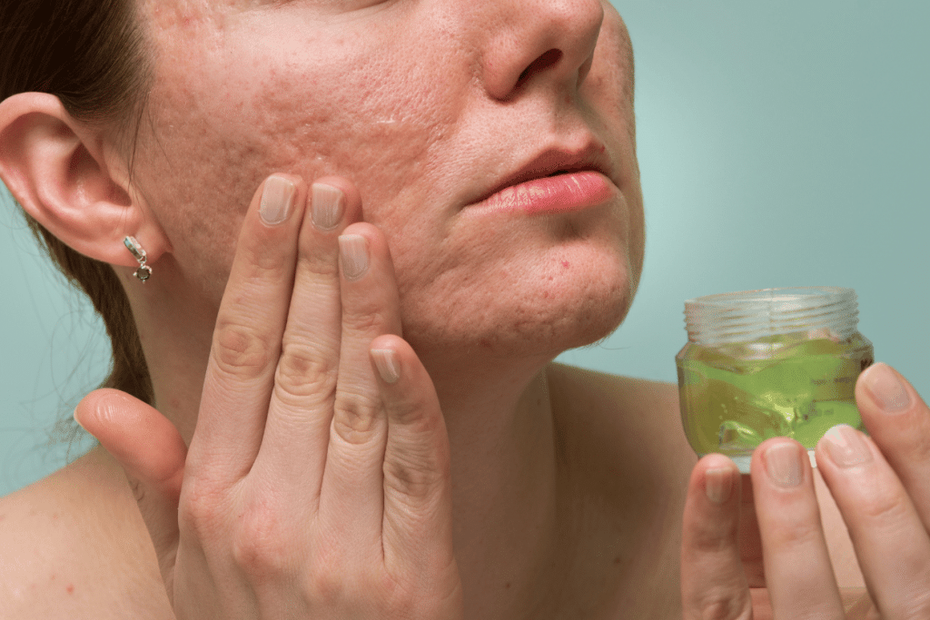 Traitements pour remédier à l'acné sévère