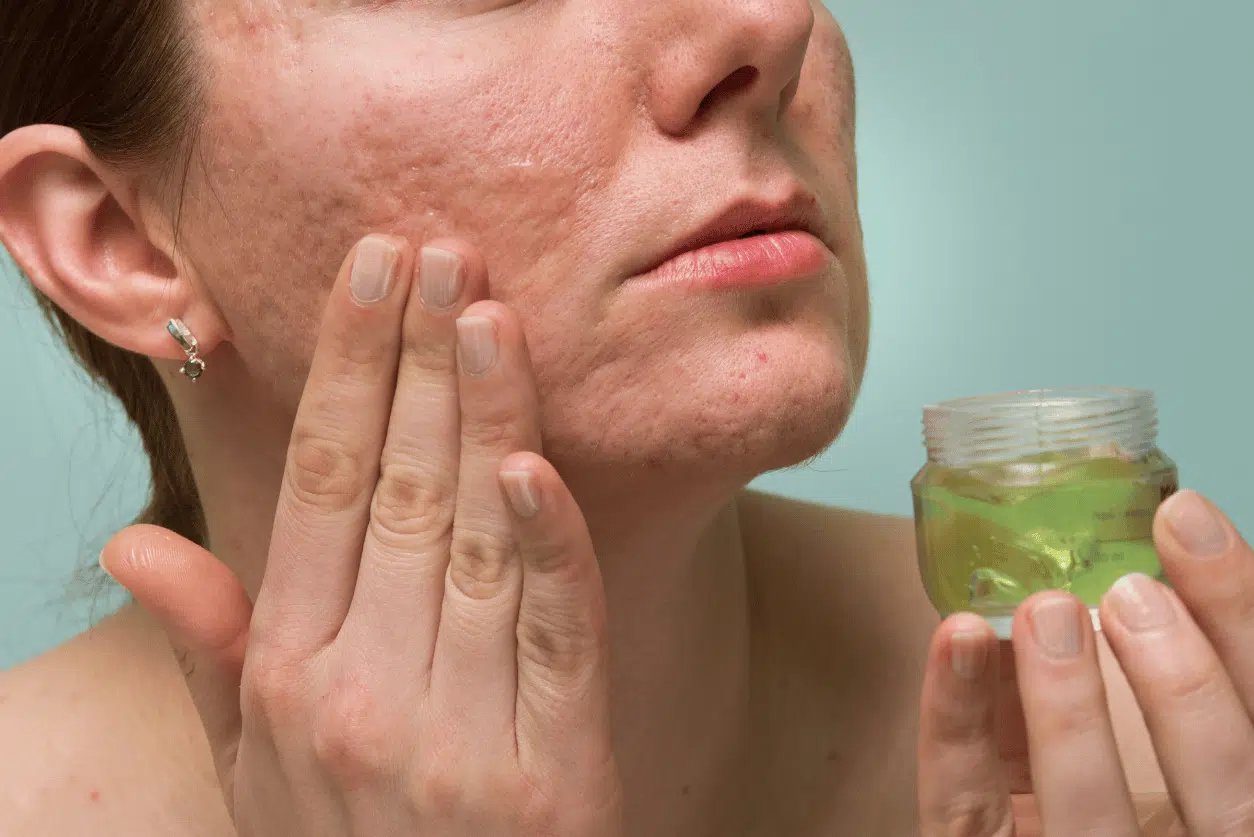 Traitements anti-acné : soins ciblés pour peau acnéique Soins et traitements topiques pour combattre l'acné sévère