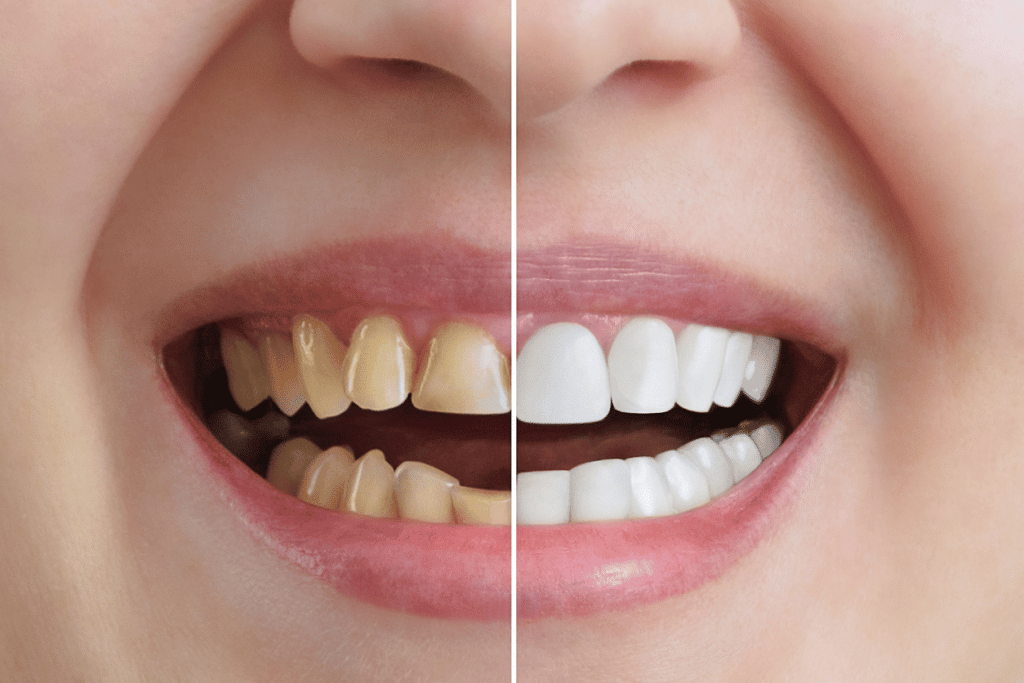 Facettes dentaires amélioration esthétique sourire éclatant