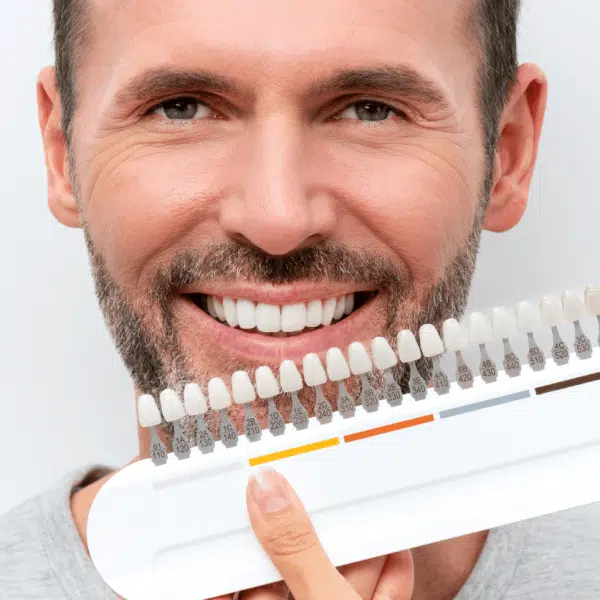 Facettes dentaires une solution esthétique pour le sourire