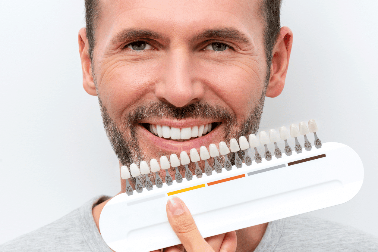 You are currently viewing Facettes dentaires : une solution esthétique pour le sourire