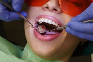 Détartrage dentaire, geste essentielle pour la santé buccale