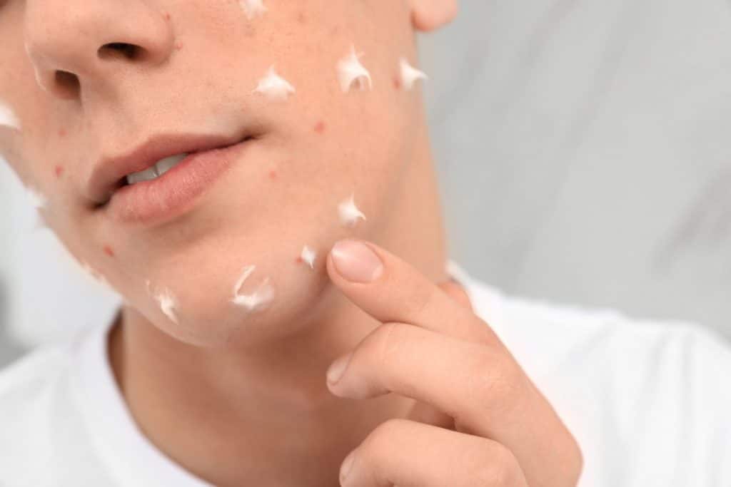 Quels produits de beauté choisir pour éliminer l'acné