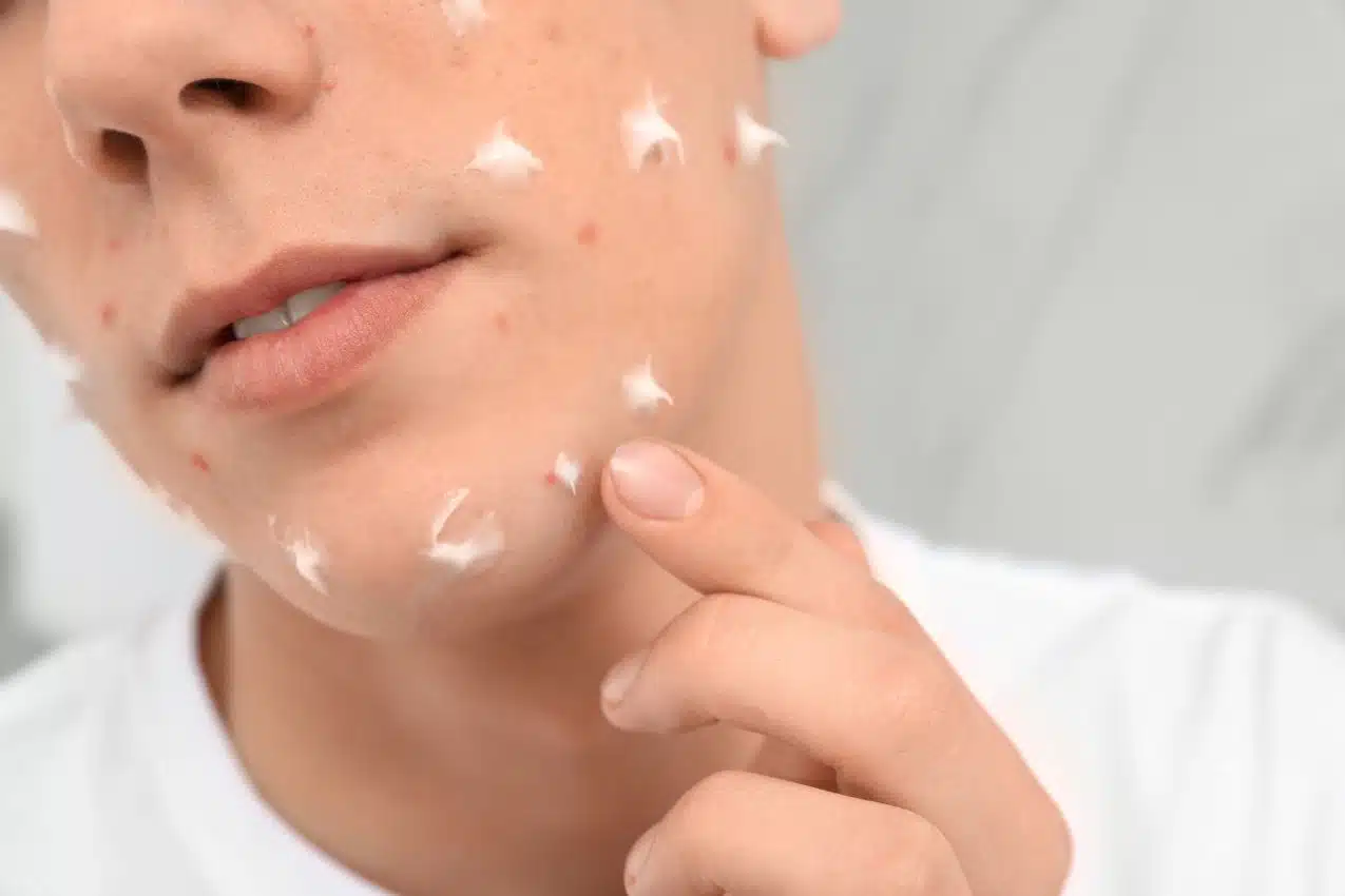 Quels produits de beauté choisir pour éliminer l'acné Quels produits de beauté choisir pour éliminer l'acné