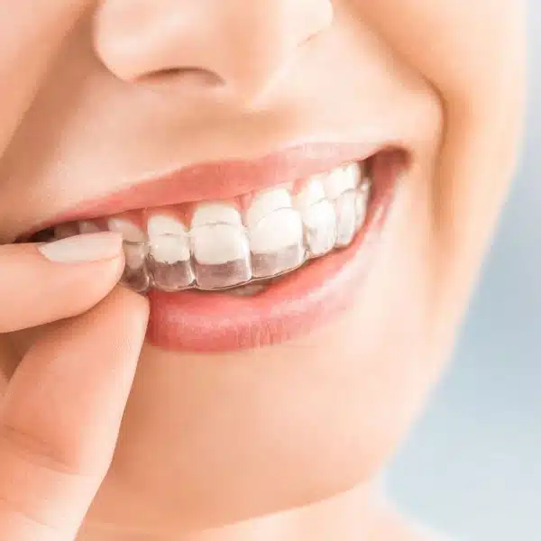 Aligneurs dentaires pour adultes retrouvez le sourire