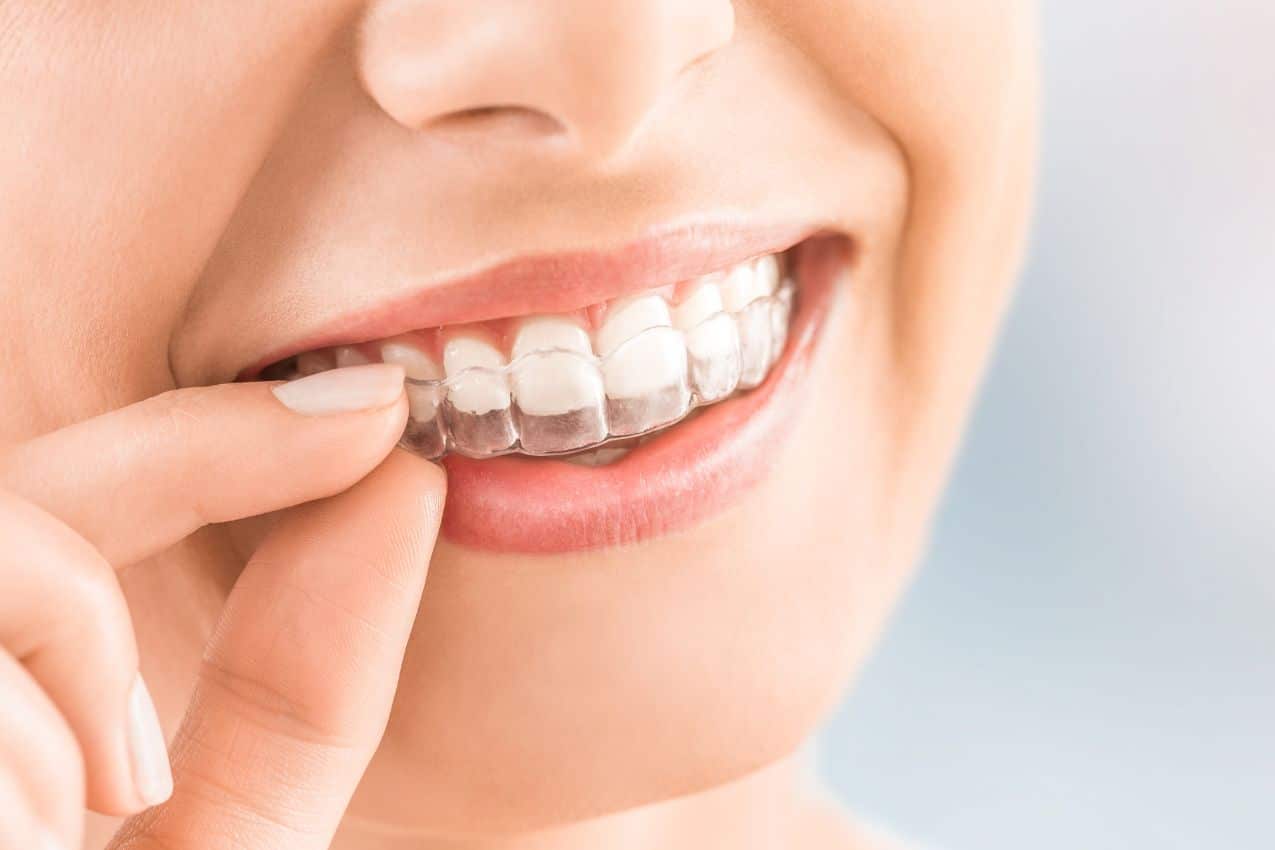 Aligneurs dentaires pour adultes retrouvez le sourire
