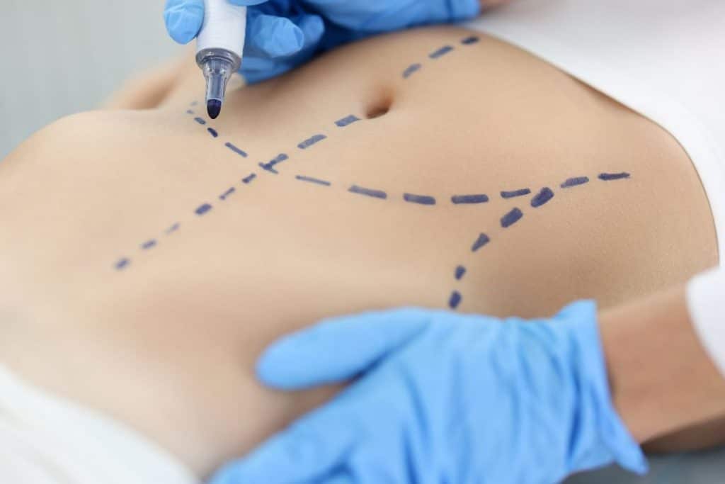 Abdominoplastie