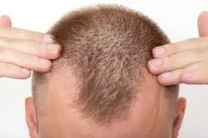 Greffe de cheveux en Turquie des techniques avancées à des prix abordables