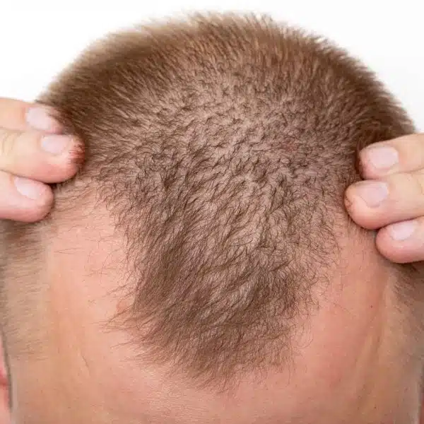 Greffe de cheveux en Turquie des techniques avancées à des prix abordables