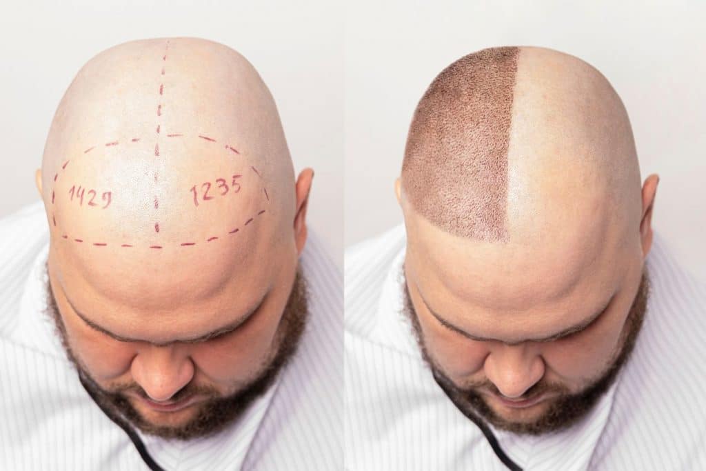 Greffe de cheveux en Turquie intervention chirurgicale FUE DHI