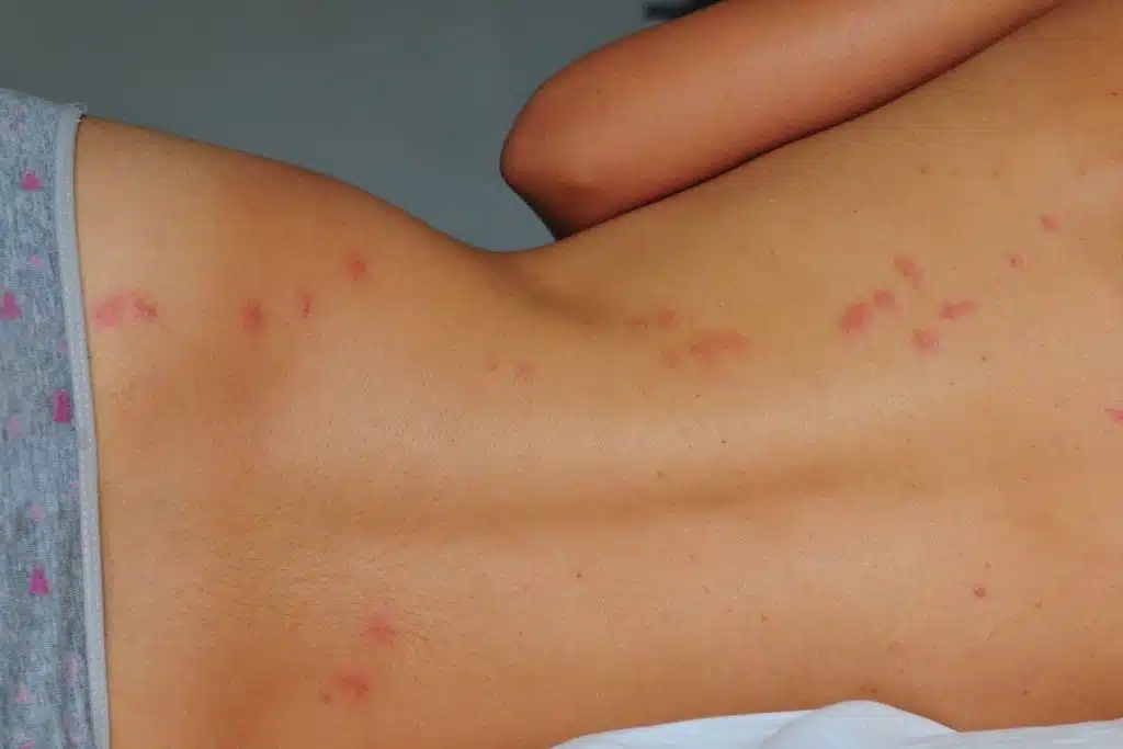démangeaison piqûre punaise de lit, rougeur, réaction allergique, plaie