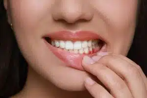 inflammation gencives enflammées, hyalugel-gel-buccal, douleur gencive, gencive infectée, gencive qui saigne, gencives gonflées