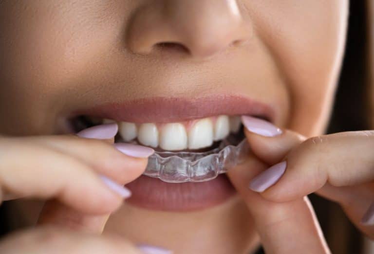 Lire la suite à propos de l’article Prévenir le bruxisme : les avantages de la gouttière dentaire