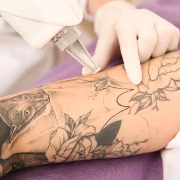 Détatouage laser, enlever un tatouage raté, tatouage doigt, détatouage avant après, détatouage prix