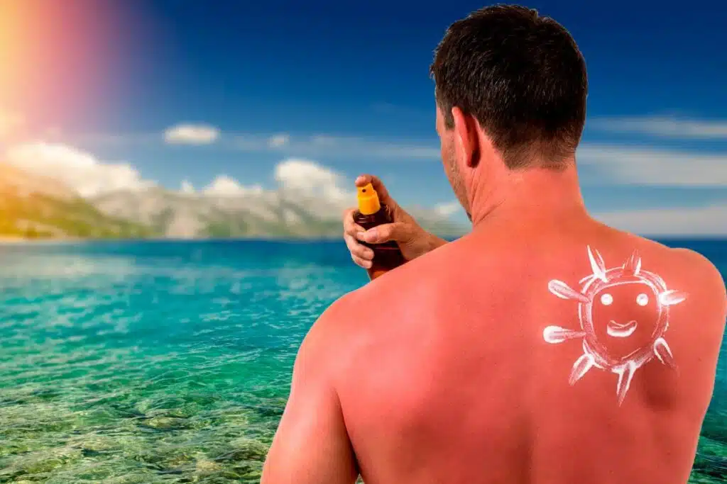 Burn lines tendance TikTok. Coups de soleil volontaires comme accessoire de beaute. Brulures, cloques, cicatrices... Crème solaire SPF 30 ou 50 (2)