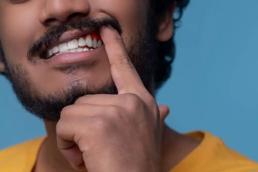 Gencives qui saignent, gencive gonflée, saignement au brossage, déchaussement des dents, dentiste, traitement des gencives, gingivite, infection des gencives, prévention dentaire, santé des gencives