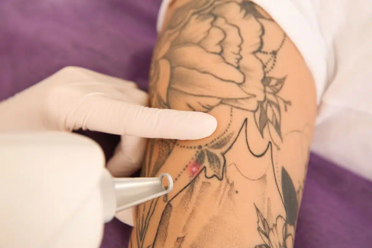 Épilation laser et détatouage le laser esthétique au quotidien Épilation laser et détatouage le laser esthétique au quotidien