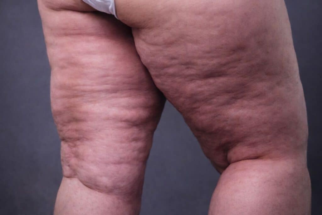 Lipœdème quand la graisse fait mal, symptômes, diagnostic et solutions