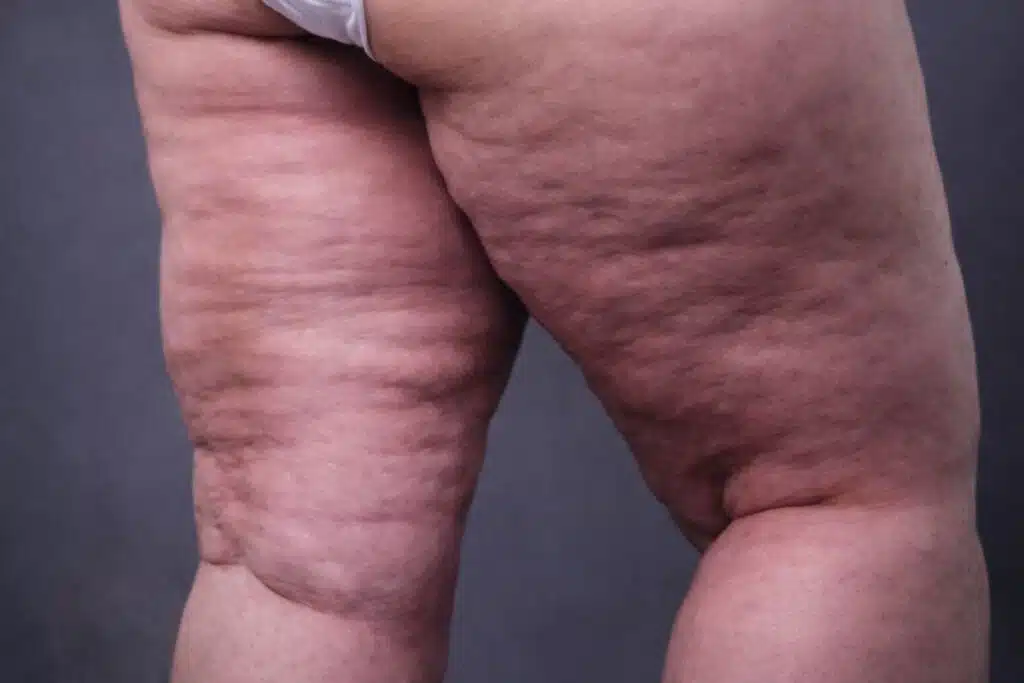 Lipœdème quand la graisse fait mal, symptômes, diagnostic et solutions