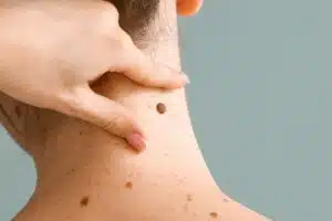 Enlever un grain de beauté sans chirurgie méthodes sûres, précautions essentielles, prix et résultats. Les solutions fiables pour agir sans risque.