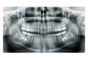 Radiographie panoramique dentaire montrant la position d'une dent de sagesse en fond de mâchoire