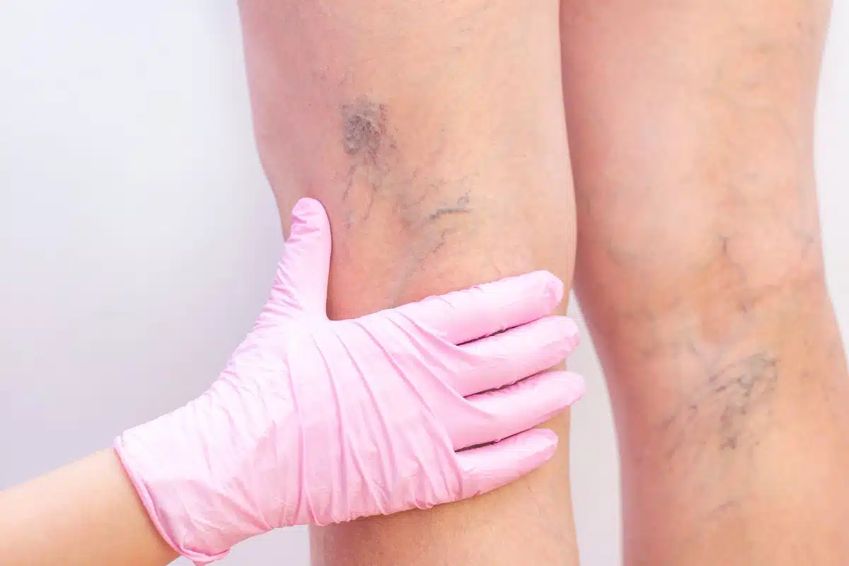 Examen de varicosités sur la jambe par un professionnel de santé ganté