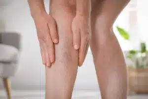 Femme se tenant la jambe, varices visibles sur le mollet