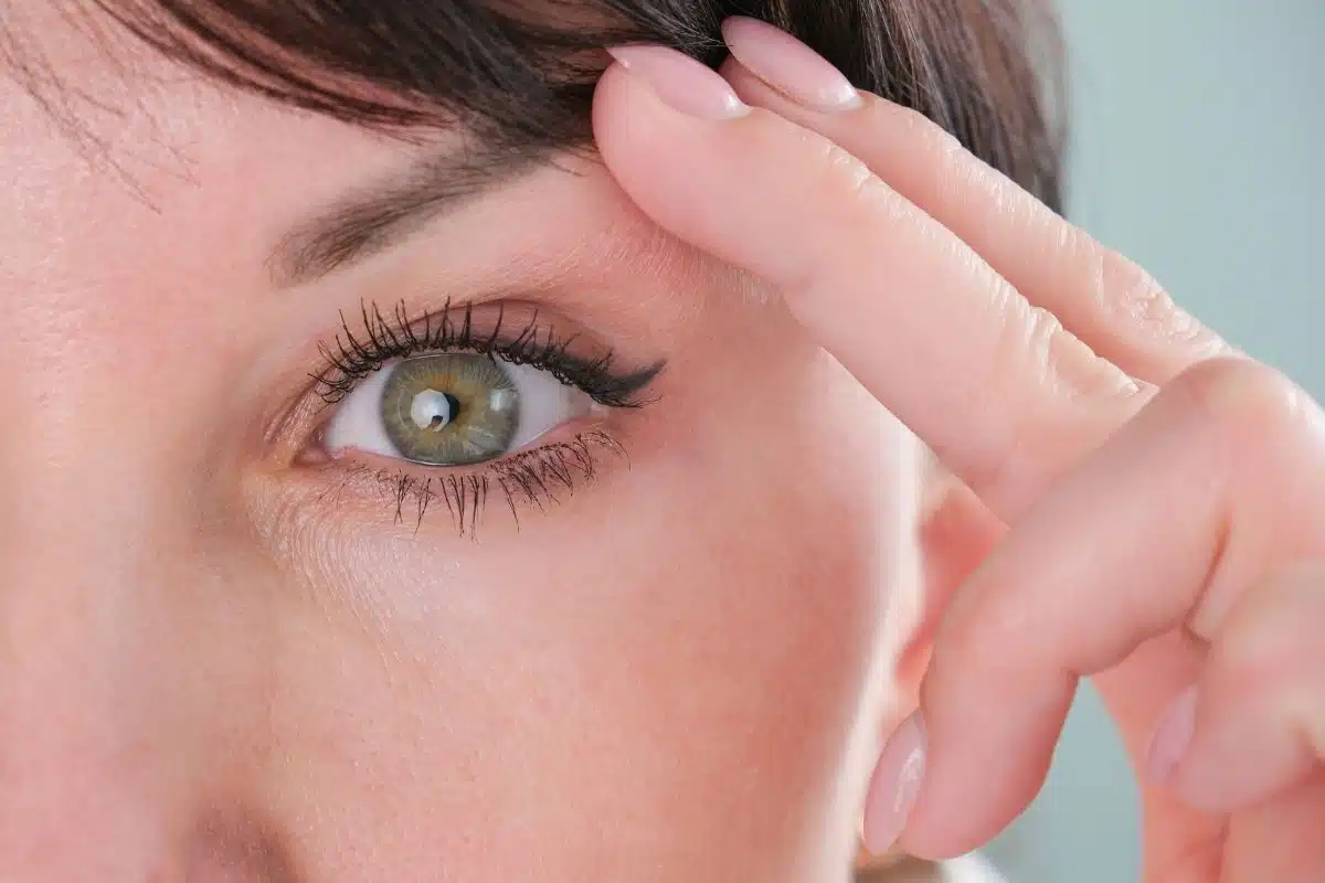 blepharoplastie