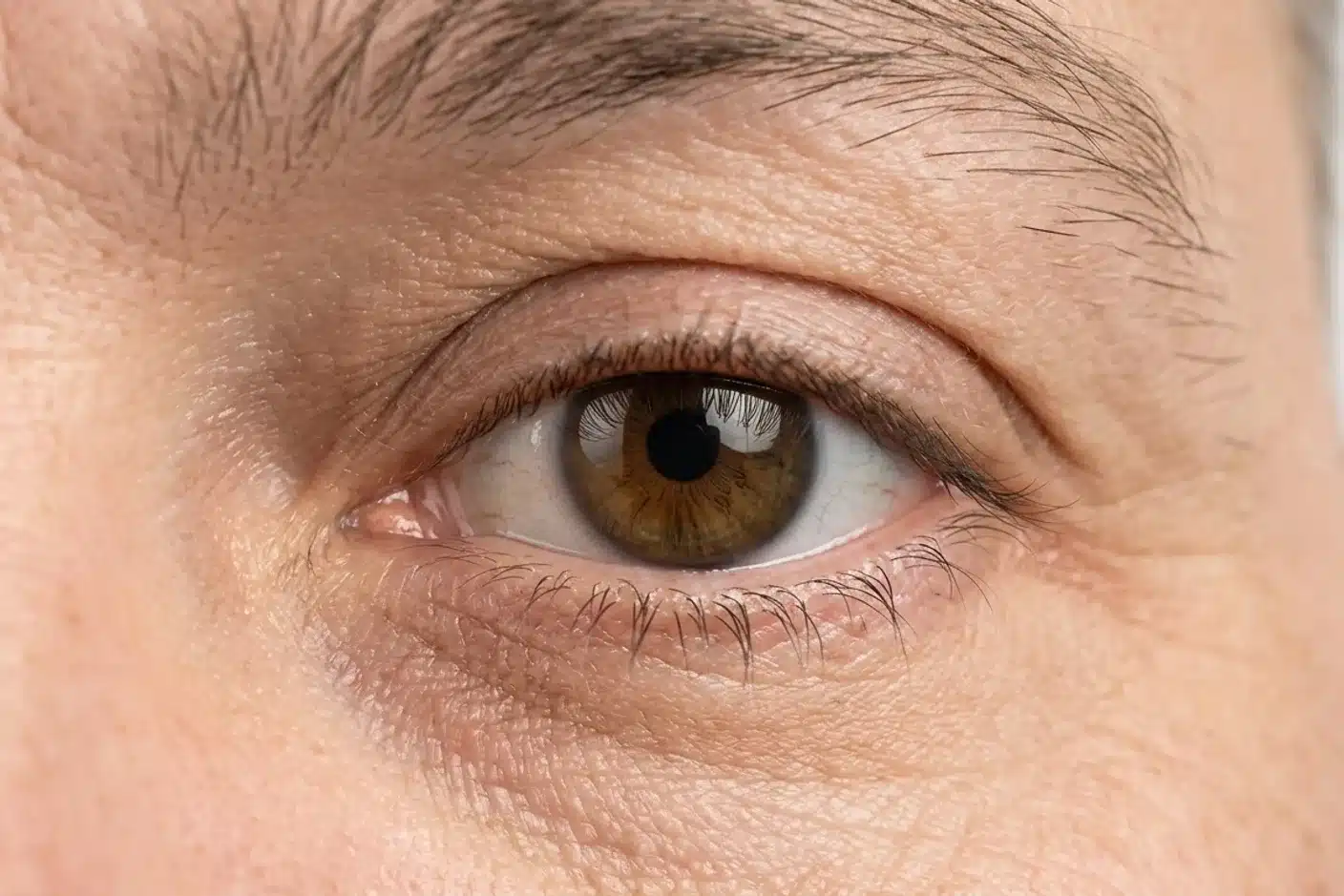 Gros plan sur une paupière supérieure tombante Gros plan clinique d'un oeil ouvert avec paupière supérieure abaissée, fond blanc
