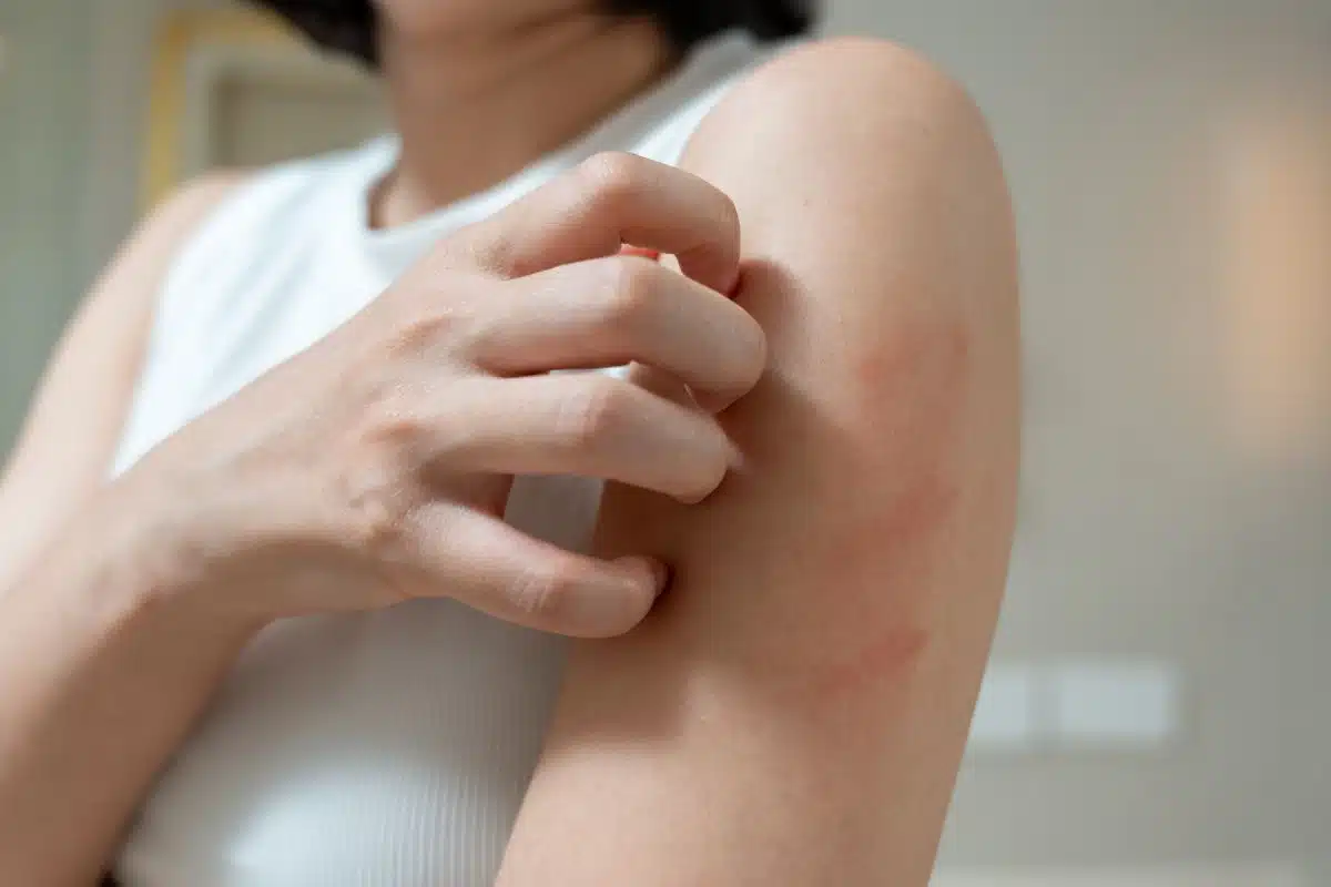 Femme se grattant le bras, rougeurs et démangeaisons d'une peau à tendance atopique