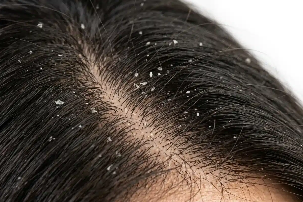 Cuir chevelu avec pellicules visibles sur des mèches sombres