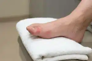Pied nu posé sur une serviette blanche avec le gros orteil rouge et gonflé autour de l'ongle