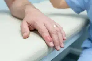 Main d'adulte présentant l'extrémité d'un doigt rouge et légèrement gonflée autour de l'ongle