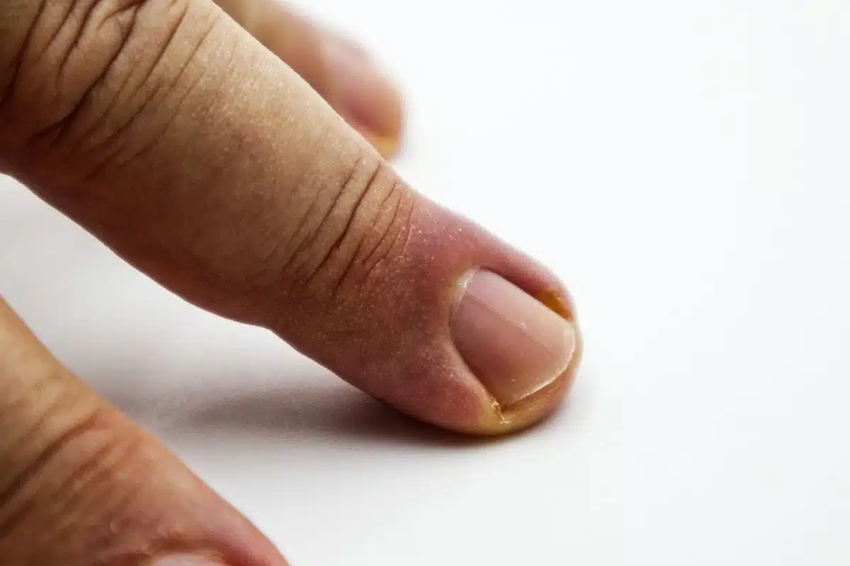 Panaris inflammatoire : rougeur et gonflement du pourtour de l'ongle Panaris au stade inflammatoire : rougeur et gonflement autour de l'ongle, sans pus