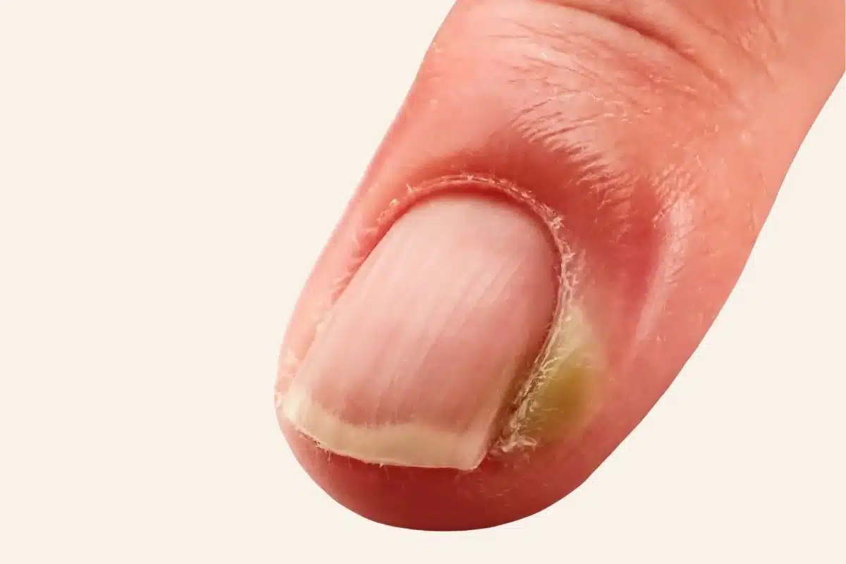 Panaris purulent : poche de pus au bord de l'ongle Panaris au stade purulent : foyer de pus jaunâtre au coin de l'ongle d'un doigt